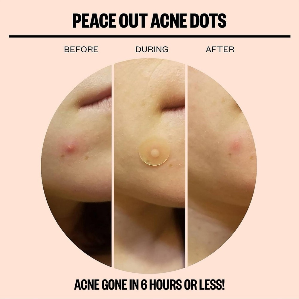 Peace Out Salicylic Acid Acne Healing Dots | NEW | 20 Count | BNIB - Picture 5 of 12